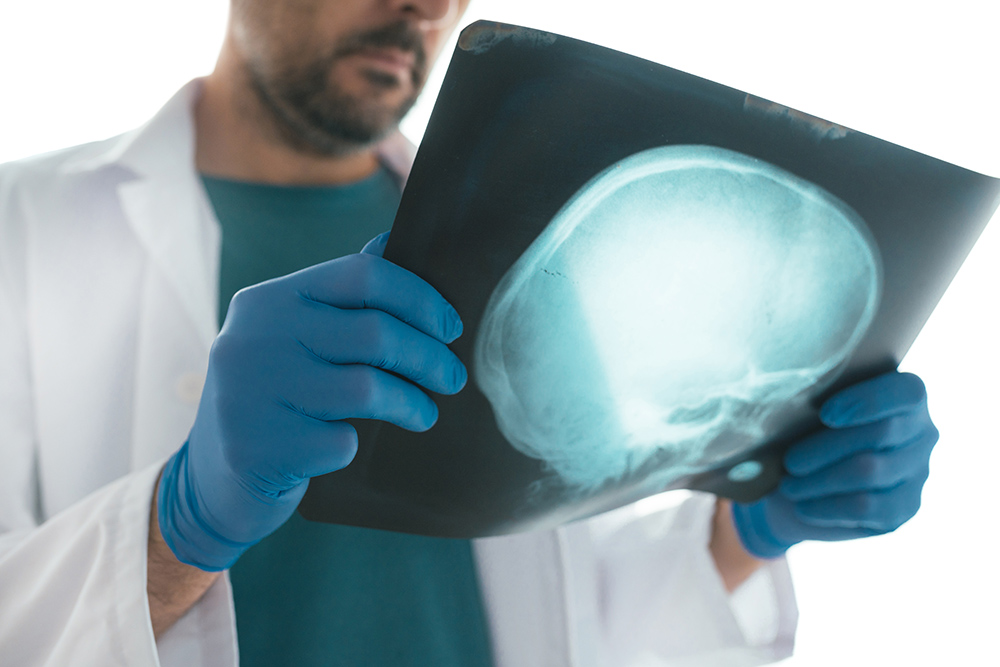 traumatic brain injury lawyer Los Angeles